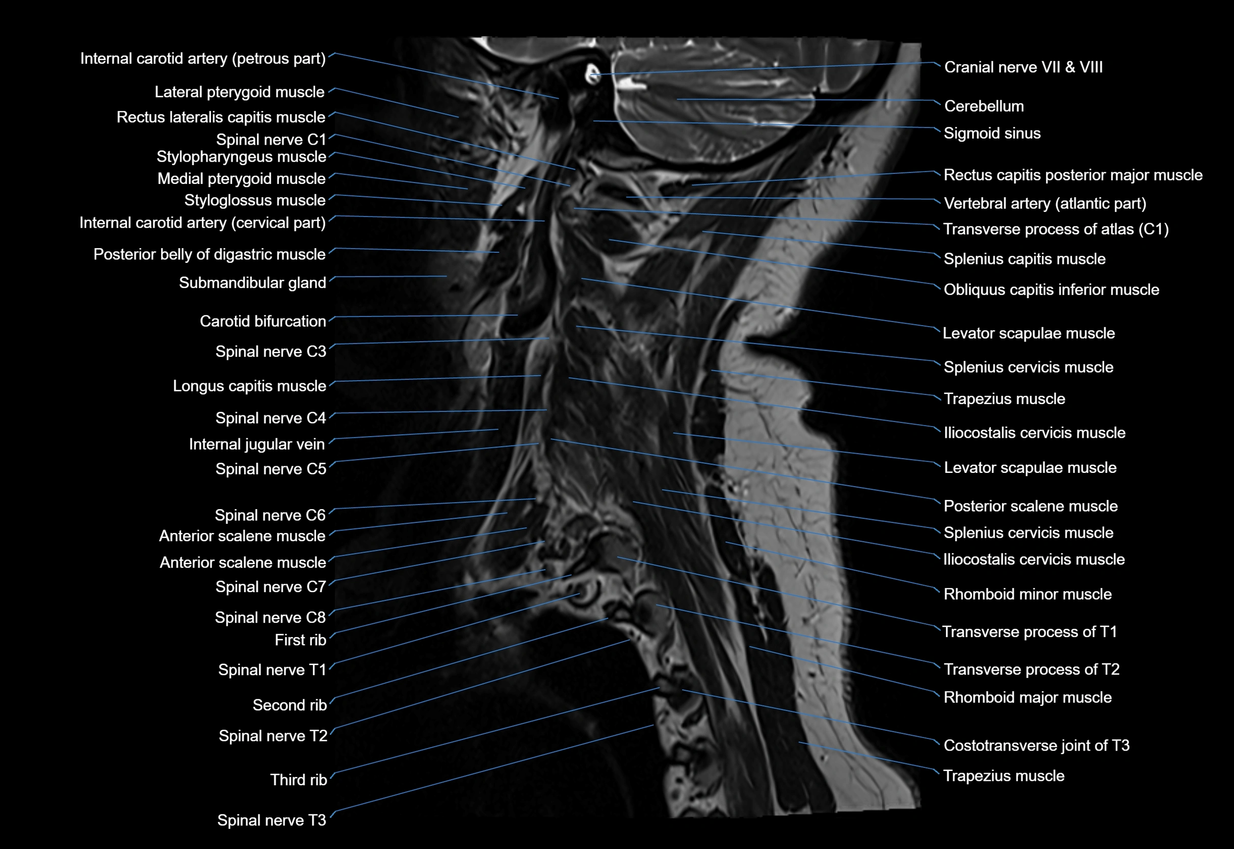 cervical spine cross sectional MRI anatomy 3T MRI  sagittal image-img-00001-00030.webp
